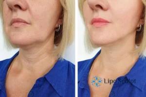 Double chin before and after Hi-Fu treatment 4 Book your double chin treatment Impington today! We are here to help!