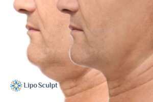 Double chin before and after Hi-Fu treatment 2 Double chin treatment Impington from Lipo Sculpt - feel more confident today!