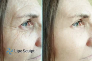 How to Fight Aging Symptoms 2 Do you want to Fight Aging Symptoms Impington? Contact Lipo Sculpt today!