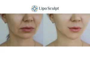 Explaining Total Skin Tightening Treatment And What It Can Do For You 2 Do you want to boost your self confidence? Give Morpheus8 Impington a try today!