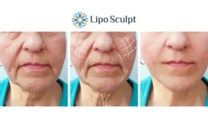 Explaining Total Skin Tightening Treatment And What It Can Do For You 3 Boost your confidence with Morpheus8 Impington call our team today!