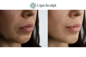 Explaining Total Skin Tightening Treatment And What It Can Do For You 4 Morpheus8 Impington the best results - call our team today!