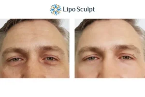Explaining Total Skin Tightening Treatment And What It Can Do For You 6 Morpheus8 Impington book in today to find out more!