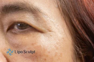 Cryopen: The Revolutionary Treatment for Age Spots Unveiled 2 Are age spots Impington giving you low self esteem? Contact us today!