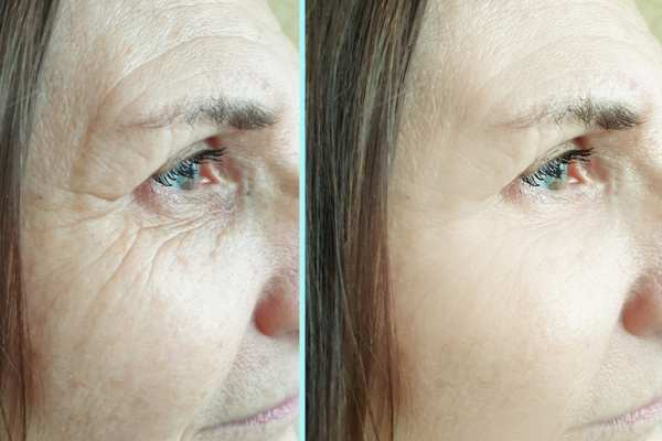 Why Do People Choose HIFU for a Non-Surgical Facelift? 4 How long can HIFU results last Impington?