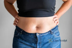 Bidding Farewell to Muffin Tops with Aqualyx Fat Injections 2 Do you wish you could reduce your muffin top Impington With Aqualy fat dissolving injections you can!