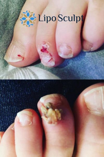 Wart removal customer results from Lipo Sculpt Impington