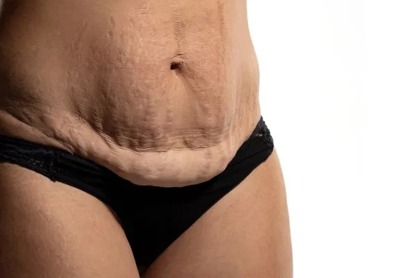 Lost the Weight but Not the Loose Skin? 1 image of womans stomach after weight loss showing loose skin Impington